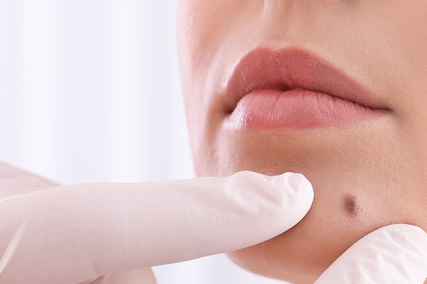 Karim Bourra - Section - Traitement des tumeurs cutanées - Chirurgie Esthétique Casablanca