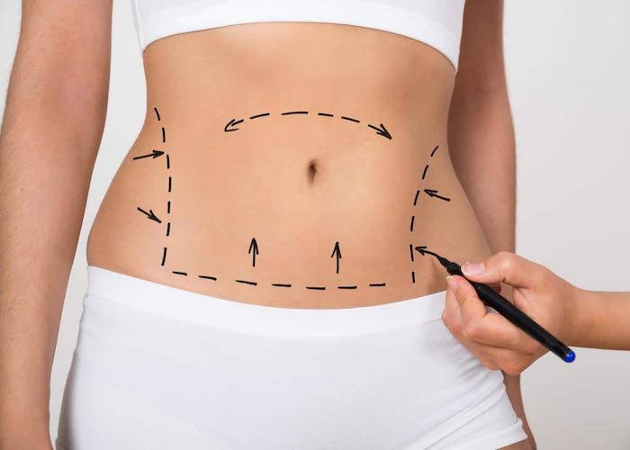 karim-bourra-chirurgie-du-corps-lipoaspiration-ou-liposuccion