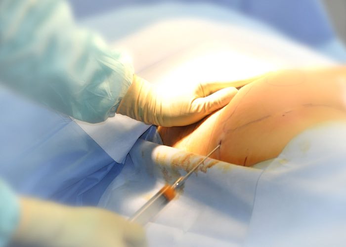 karim-bourra-chirurgie-du-corps-lipophiling-des-fesses