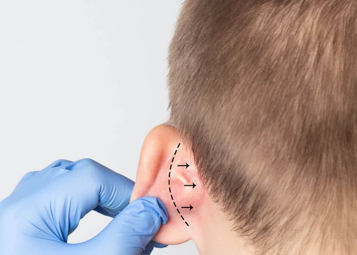 karim-bourra-chirurgie-du-visage-chirurgie-des-oreilles