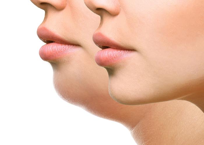 karim-bourra-chirurgie-du-visage-chirurgie-du-menton
