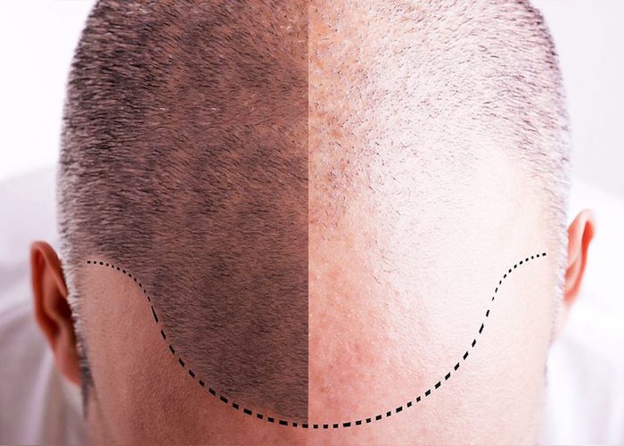 karim-bourra-greffe-de-cheveux-de-quoi-il-sagit-la-greffe-de-cheveux