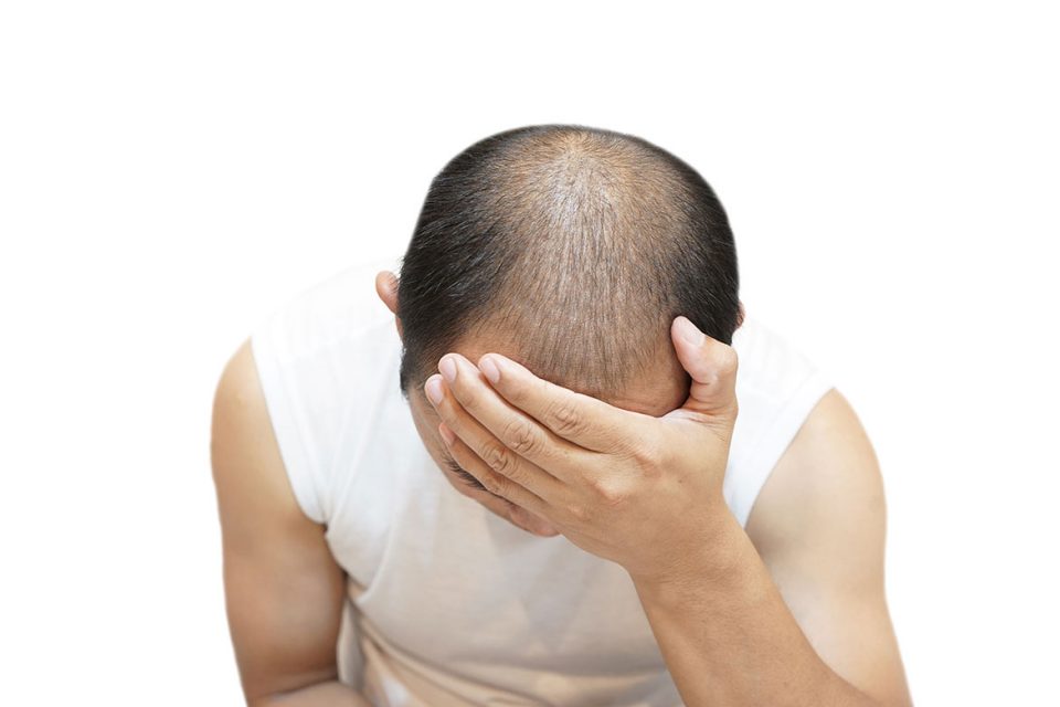 karim-bourra-greffe-de-cheveux-etes-vous-un-bon-candidat-pour-une-greffe-de-cheveux
