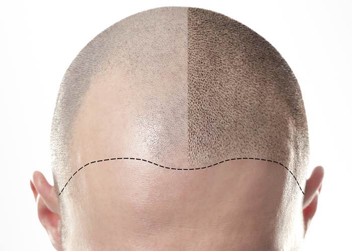 karim-bourra-greffe-de-cheveux-technique-fue