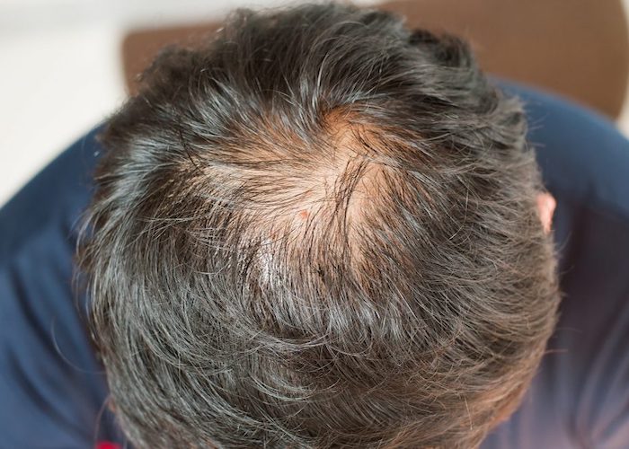 karim-bourra-perte-de-cheveux-causes-et-prevention