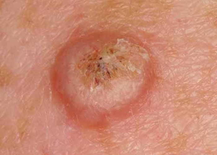 karim-bourra-tumeurs-cutanees-carcinome-spinocellulaire