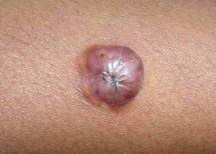karim-bourra-tumeurs-cutanees-dermatofibrosatcome-de-darrier-et-ferrand-dfs