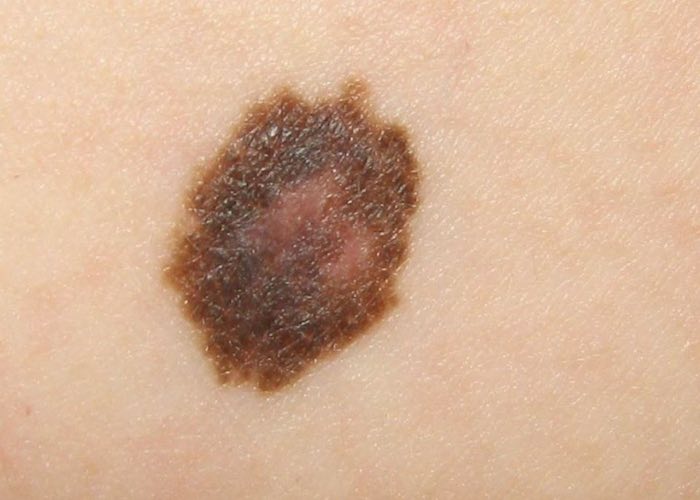 karim-bourra-tumeurs-cutanees-melanome