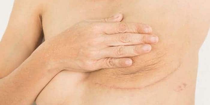 Karim Bourra - Chirurgie des seins - Les facteurs du cancer du sein - Les symptômes du cancer du sein