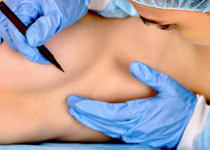 Karim Bourra - Chirurgie des seins - Reconstruction du sein après un cancer du sein